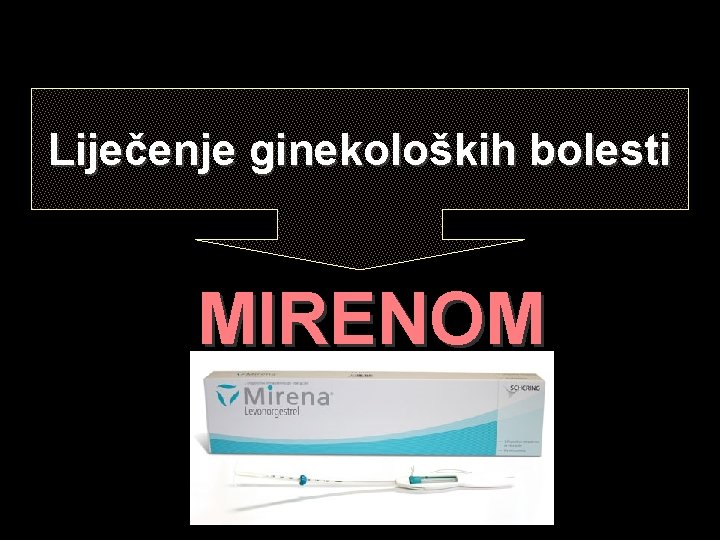 Liječenje ginekoloških bolesti MIRENOM 
