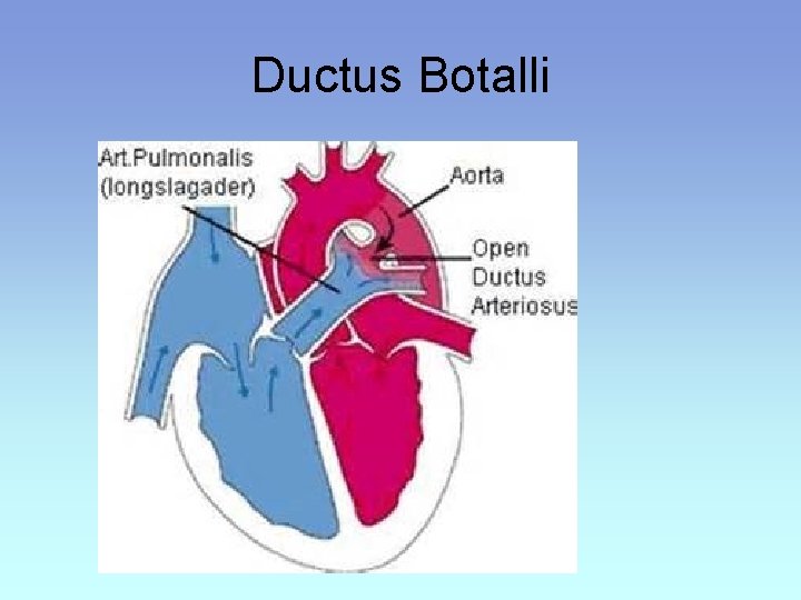 Ductus Botalli 