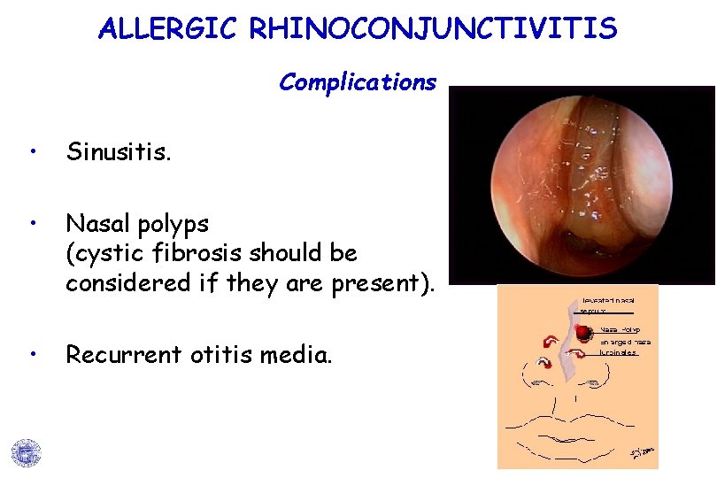 ALLERGIC RHINOCONJUNCTIVITIS Complications • Sinusitis. • Nasal polyps (cystic fibrosis should be considered if ALLERGIC RHINOCONJUNCTIVITIS Complications • Sinusitis. • Nasal polyps (cystic fibrosis should be considered if