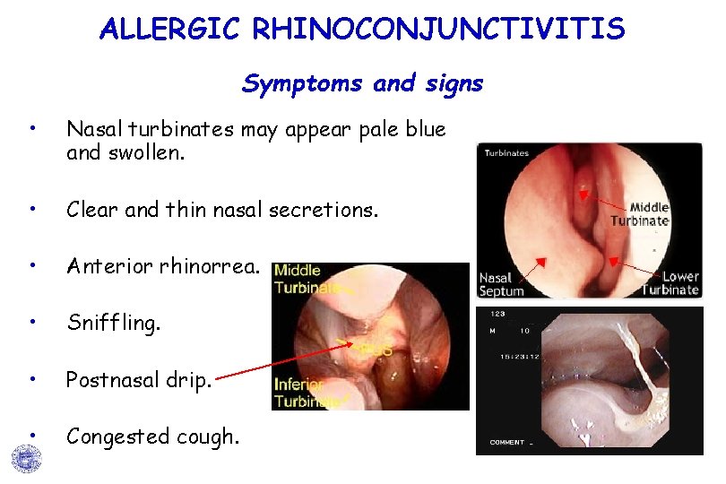 ALLERGIC RHINOCONJUNCTIVITIS Symptoms and signs • Nasal turbinates may appear pale blue and swollen. ALLERGIC RHINOCONJUNCTIVITIS Symptoms and signs • Nasal turbinates may appear pale blue and swollen.