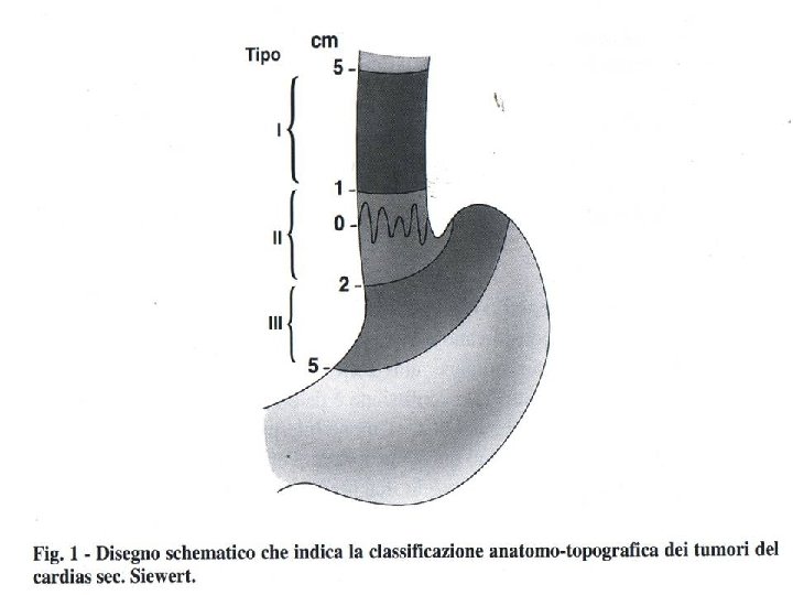 Carcinoma del cardias 