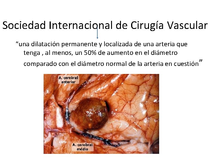 Sociedad Internacional de Cirugía Vascular “una dilatación permanente y localizada de una arteria que