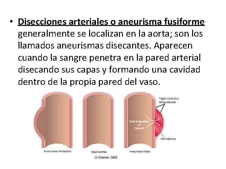  • Disecciones arteriales o aneurisma fusiforme generalmente se localizan en la aorta; son