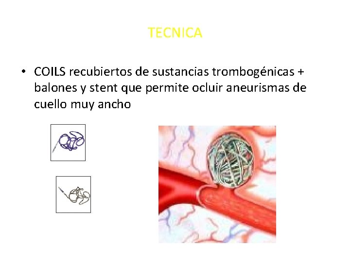 TECNICA • COILS recubiertos de sustancias trombogénicas + balones y stent que permite ocluir