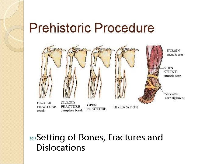 Prehistoric Procedure Setting of Bones, Fractures and Dislocations 