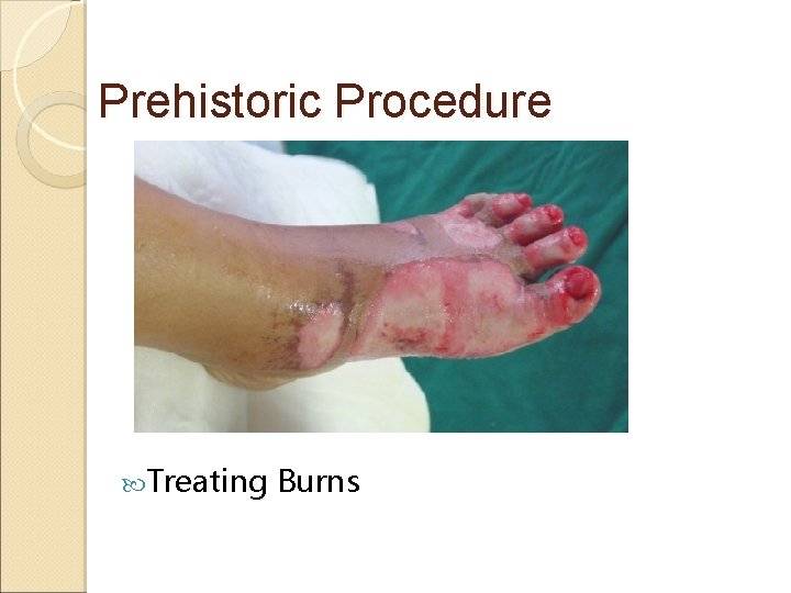 Prehistoric Procedure Treating Burns 