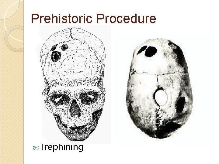 Prehistoric Procedure Trephining 