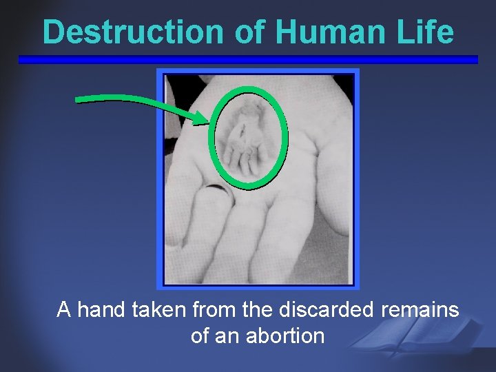 Destruction of Human Life A hand taken from the discarded remains of an abortion