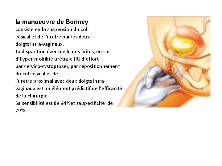 la manoeuvre de Bonney consiste en la suspension du col vésical et de l’urètre