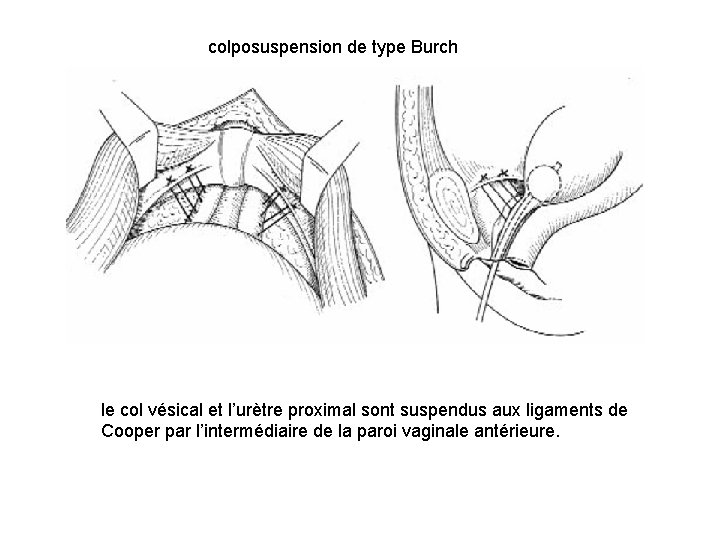 colposuspension de type Burch le col vésical et l’urètre proximal sont suspendus aux ligaments