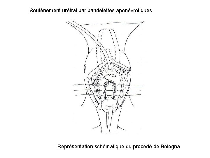 Soutènement urétral par bandelettes aponévrotiques Représentation schématique du procédé de Bologna 