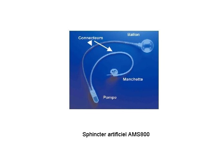Sphincter artificiel AMS 800 
