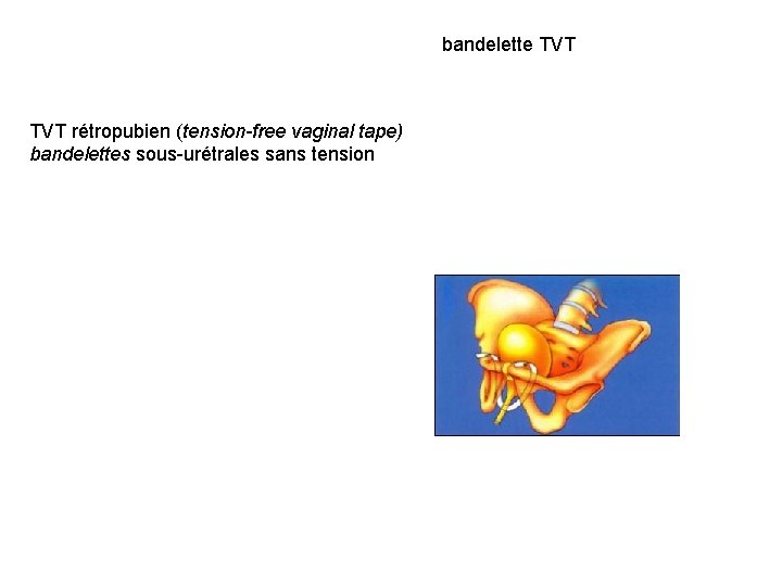 bandelette TVT rétropubien (tension-free vaginal tape) bandelettes sous-urétrales sans tension 