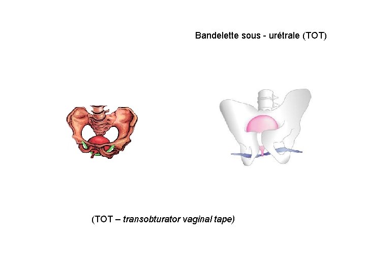 Bandelette sous - urétrale (TOT) (TOT – transobturator vaginal tape) 