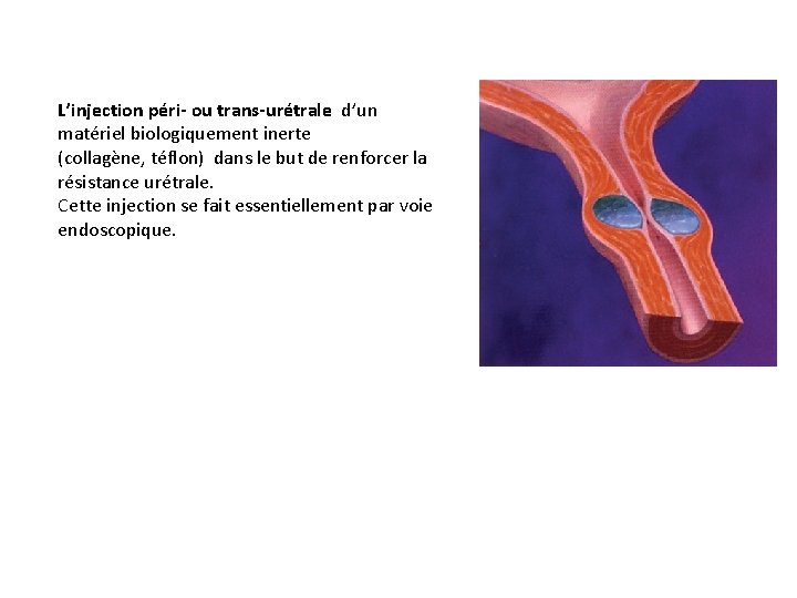 L’injection péri- ou trans-urétrale d’un matériel biologiquement inerte (collagène, téflon) dans le but de