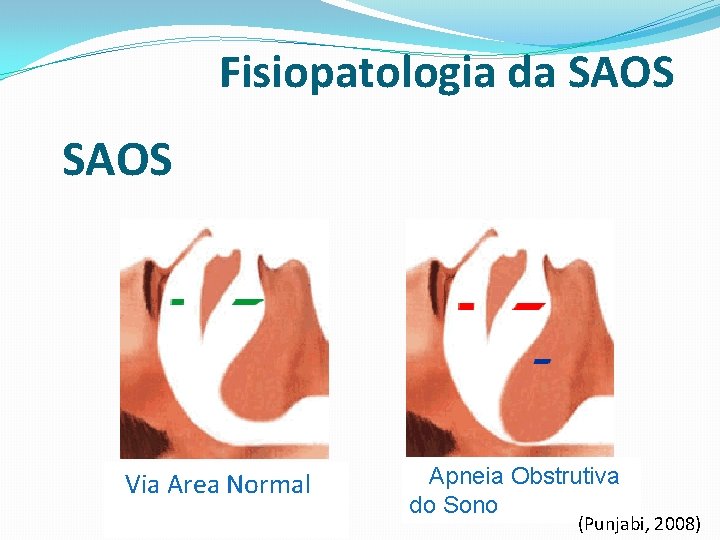 Fisiopatologia da SAOS Via Area Normal Apneia Obstrutiva do Sono (Punjabi, 2008) 