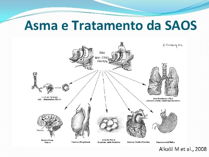 Asma e Tratamento da SAOS Alkalil M et al. , 2008 