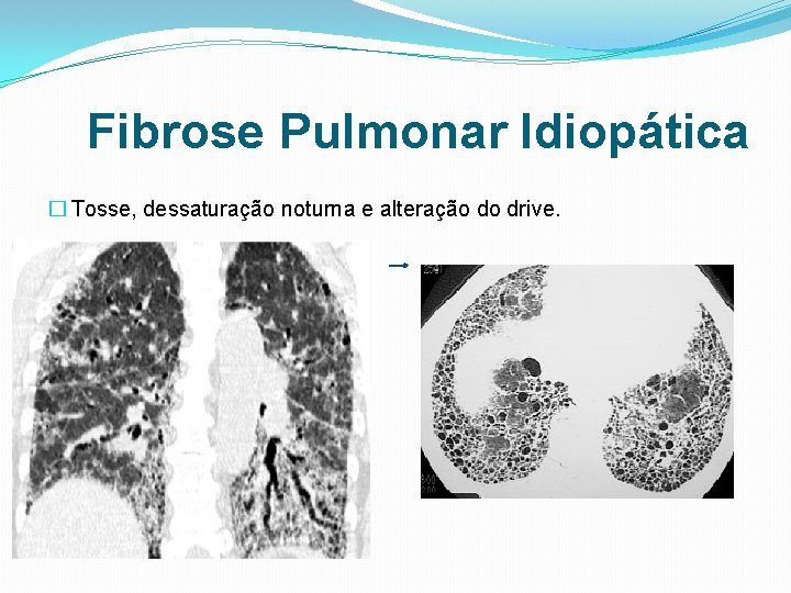 Fibrose Pulmonar Idiopática � Tosse, dessaturação noturna e alteração do drive. 