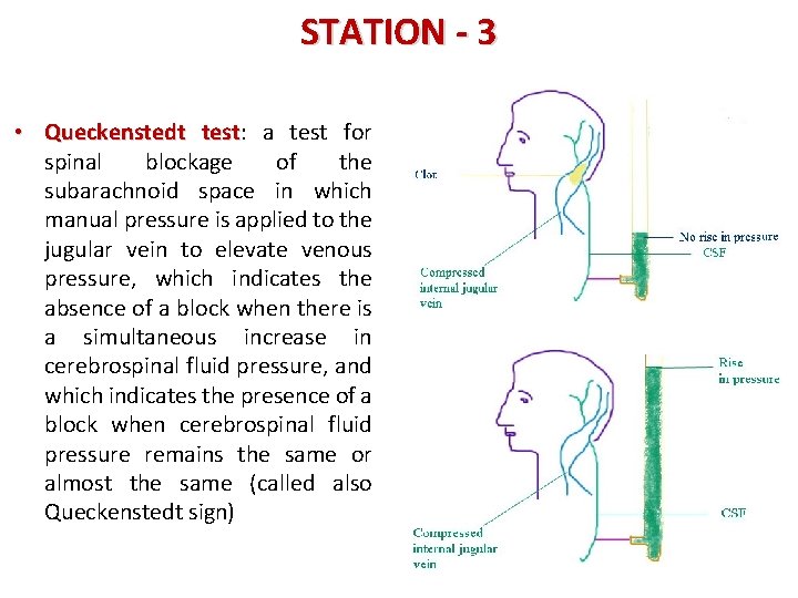 STATION - 3 • Queckenstedt test: test a test for spinal blockage of the