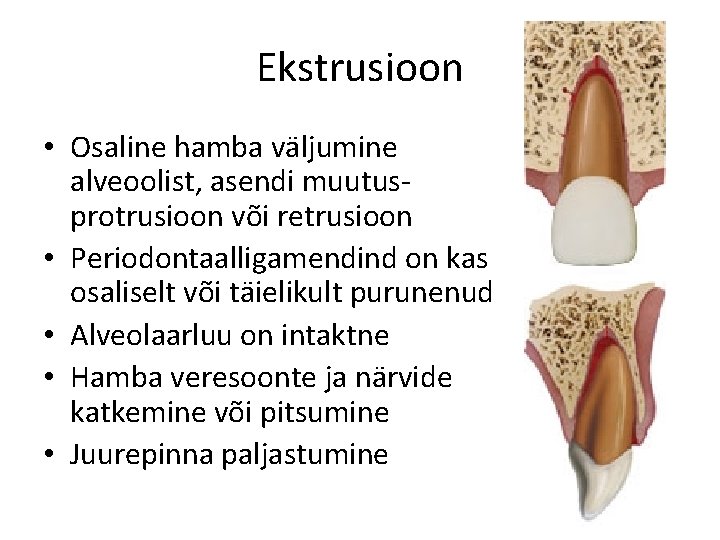 Ekstrusioon • Osaline hamba väljumine alveoolist, asendi muutusprotrusioon või retrusioon • Periodontaalligamendind on kas