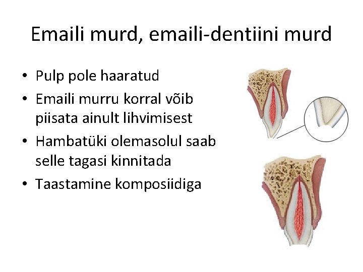 Emaili murd, emaili-dentiini murd • Pulp pole haaratud • Emaili murru korral võib piisata