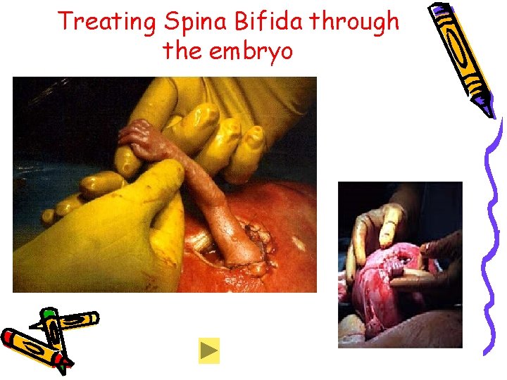 Treating Spina Bifida through the embryo Treating Spina Bifida through the embryo
