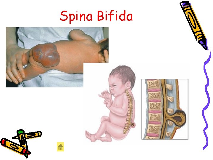 Spina Bifida Spina Bifida