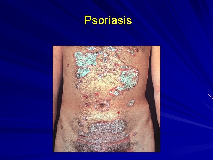 Psoriasis 