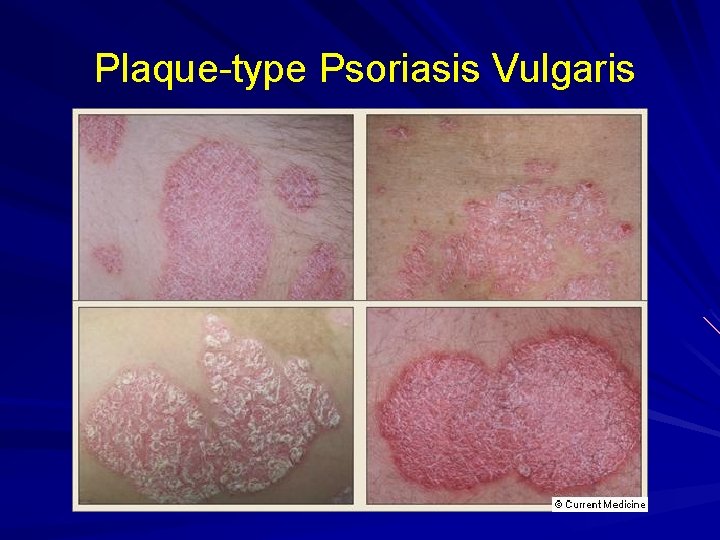 Plaque-type Psoriasis Vulgaris 
