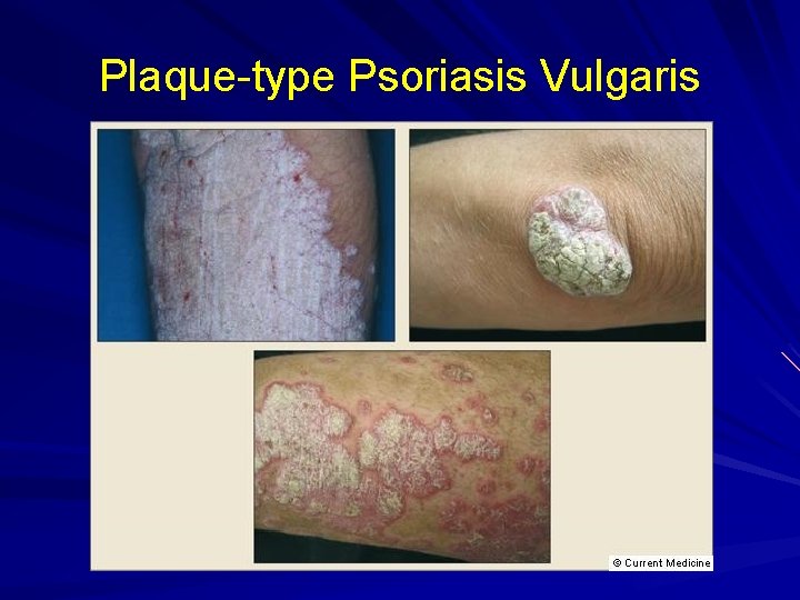 Plaque-type Psoriasis Vulgaris 