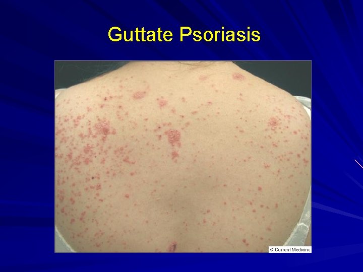 Guttate Psoriasis 