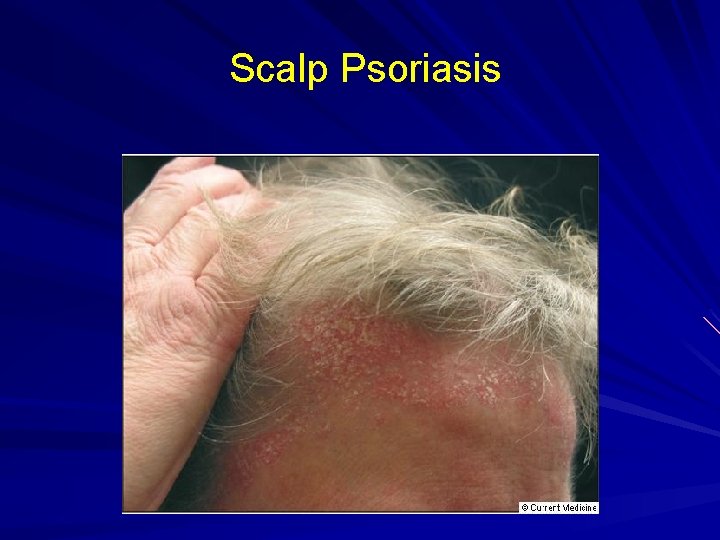 Scalp Psoriasis 