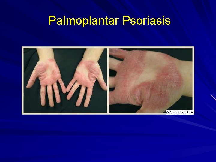 Palmoplantar Psoriasis 