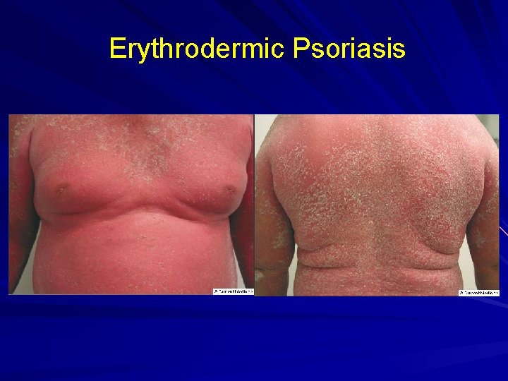 Erythrodermic Psoriasis 