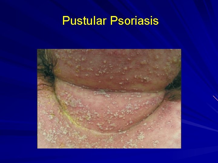 Pustular Psoriasis 