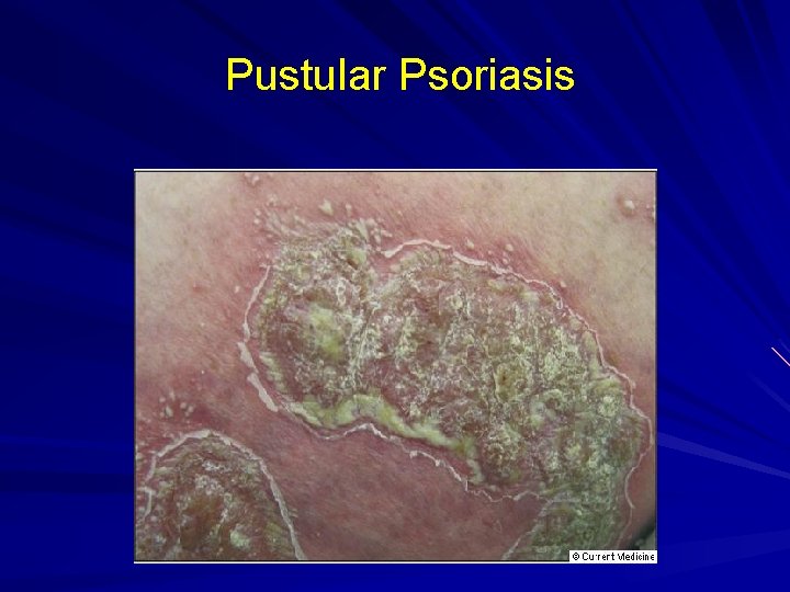 Pustular Psoriasis 