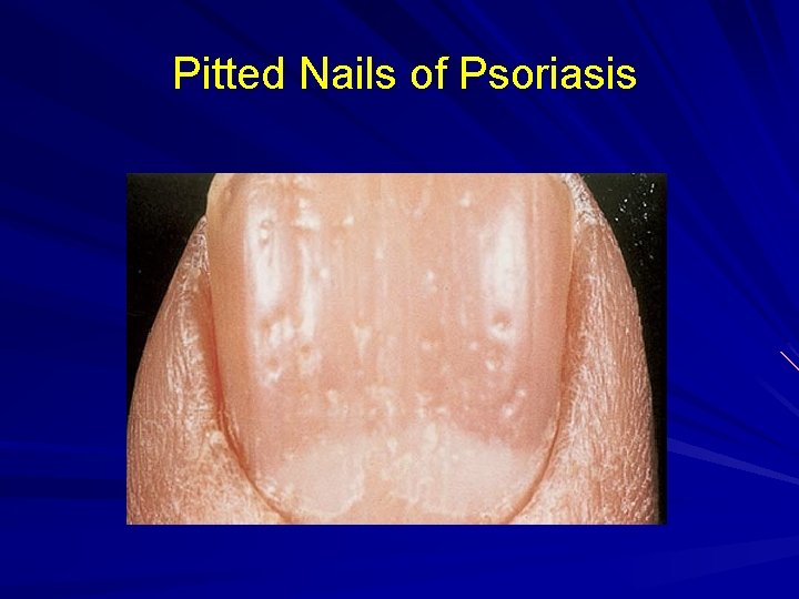 Pitted Nails of Psoriasis 