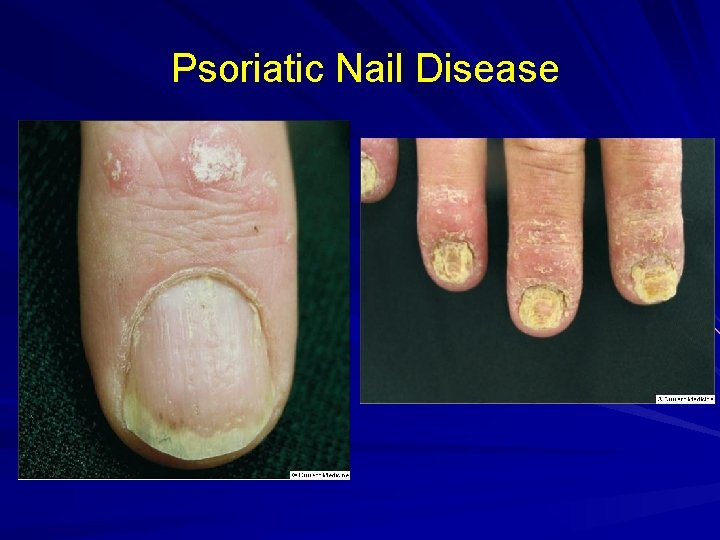 Psoriatic Nail Disease 