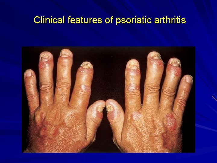Clinical features of psoriatic arthritis 