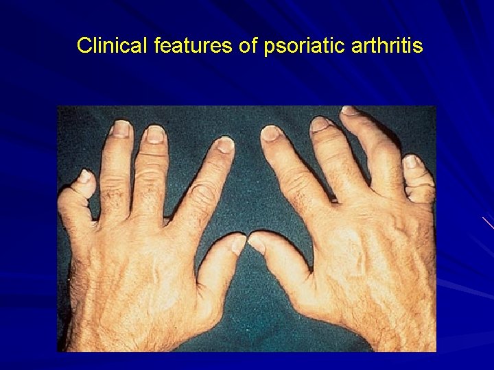 Clinical features of psoriatic arthritis 