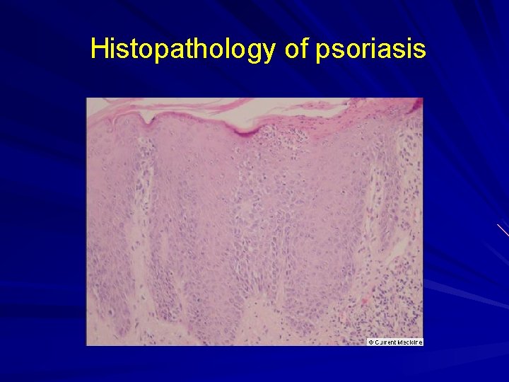 Histopathology of psoriasis 