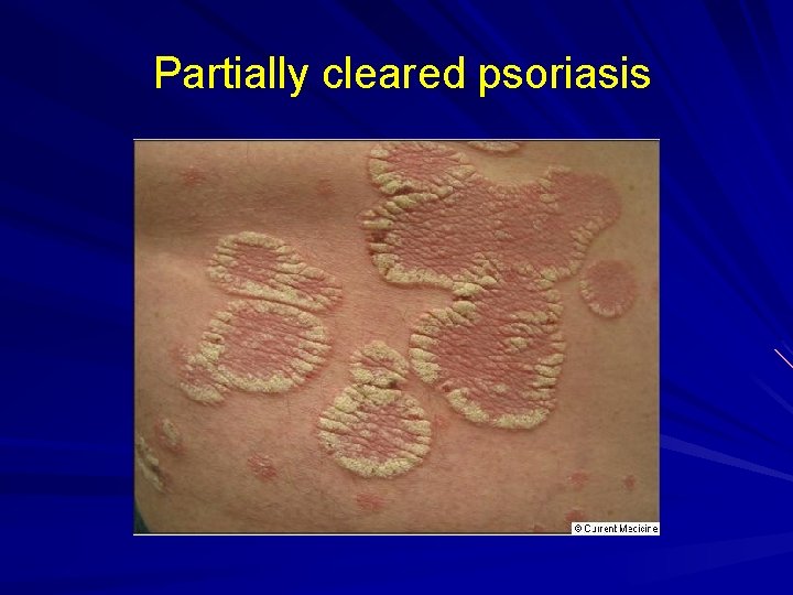 Partially cleared psoriasis 