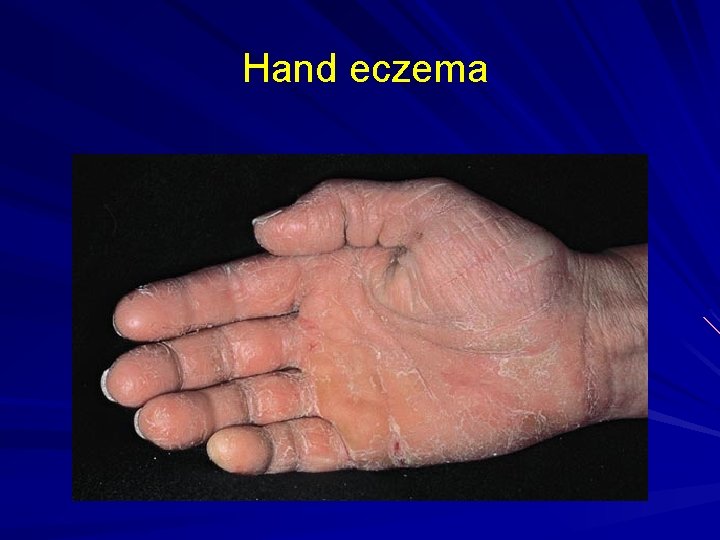 Hand eczema 