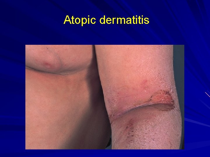 Atopic dermatitis 