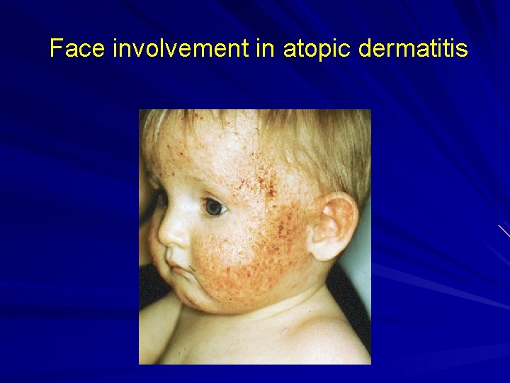 Face involvement in atopic dermatitis 