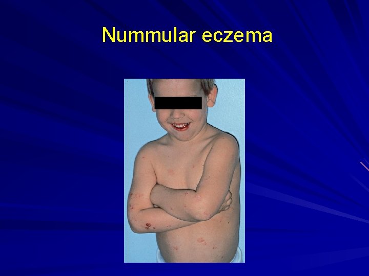 Nummular eczema 