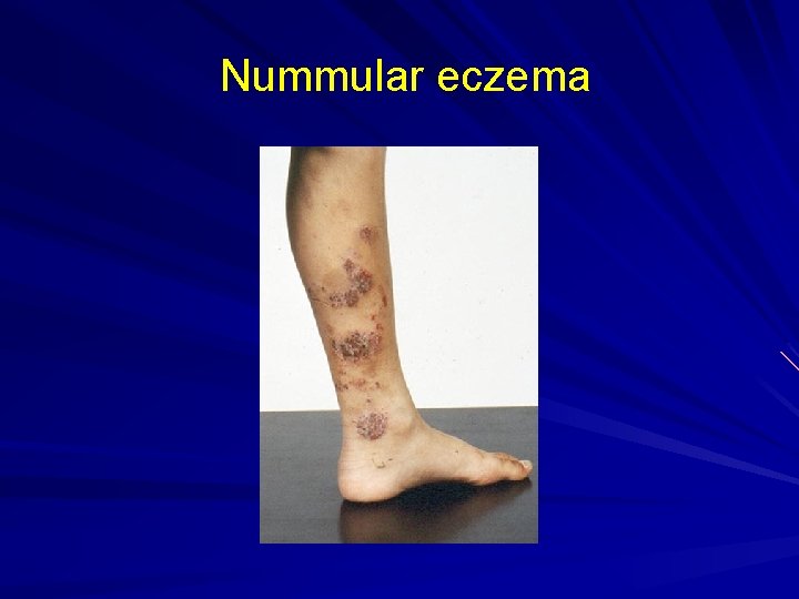 Nummular eczema 