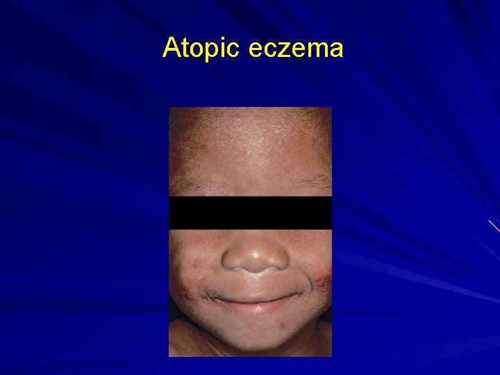 Atopic eczema 