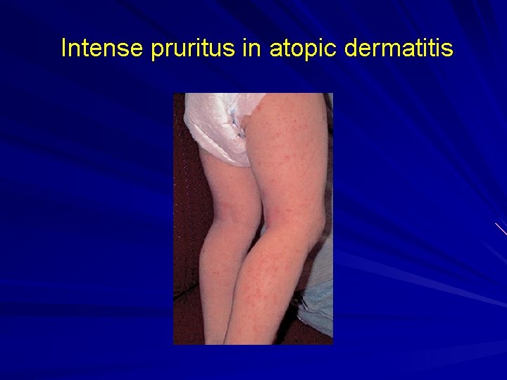 Intense pruritus in atopic dermatitis 