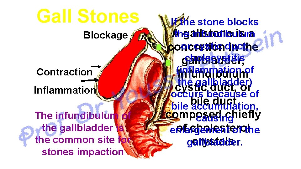 Gall Stones Blockage Contraction Inflammation The infundibulum of the gallbladder is the common site